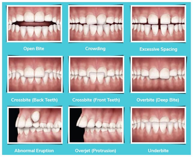 Orthodontic Problems in Children: Visual Examples and Solutions