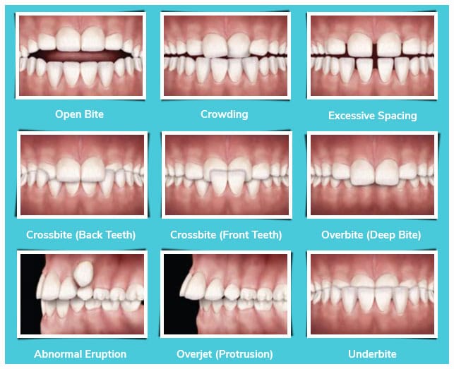 Braces vs. Invisalign: A Visual Guide to Your Orthodontic Treatment Options