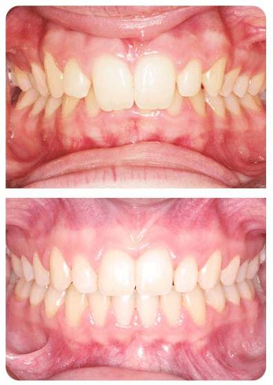 Orthodontic treatment