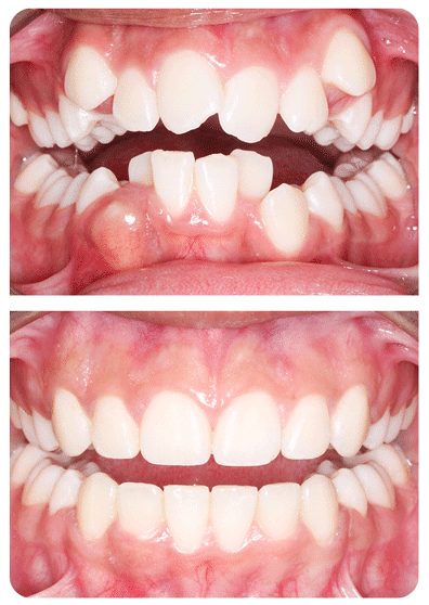 orthodontist results before and after