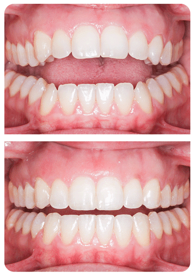 Orthodontic Treatment In Toronto