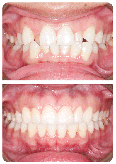 Orthodontist Photos Before and After