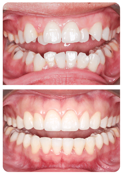 Experienced Orthodontist Toronto before and after