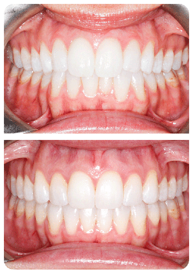 Top Rated Orthodontist Before and After