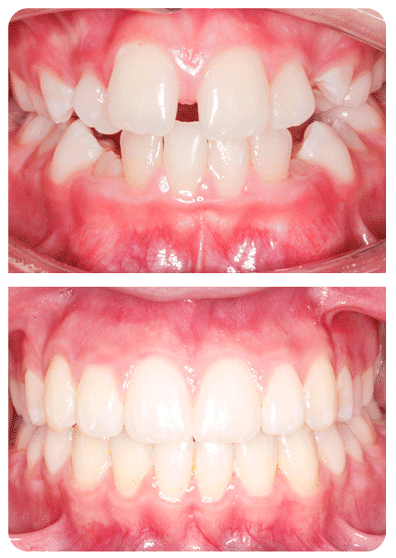 braces or invisalign consultation