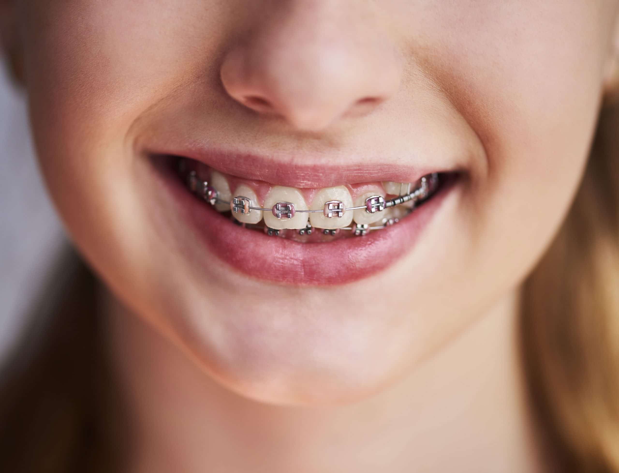 Preparing Your Child for Orthodontic Treatment: A Guide to Braces