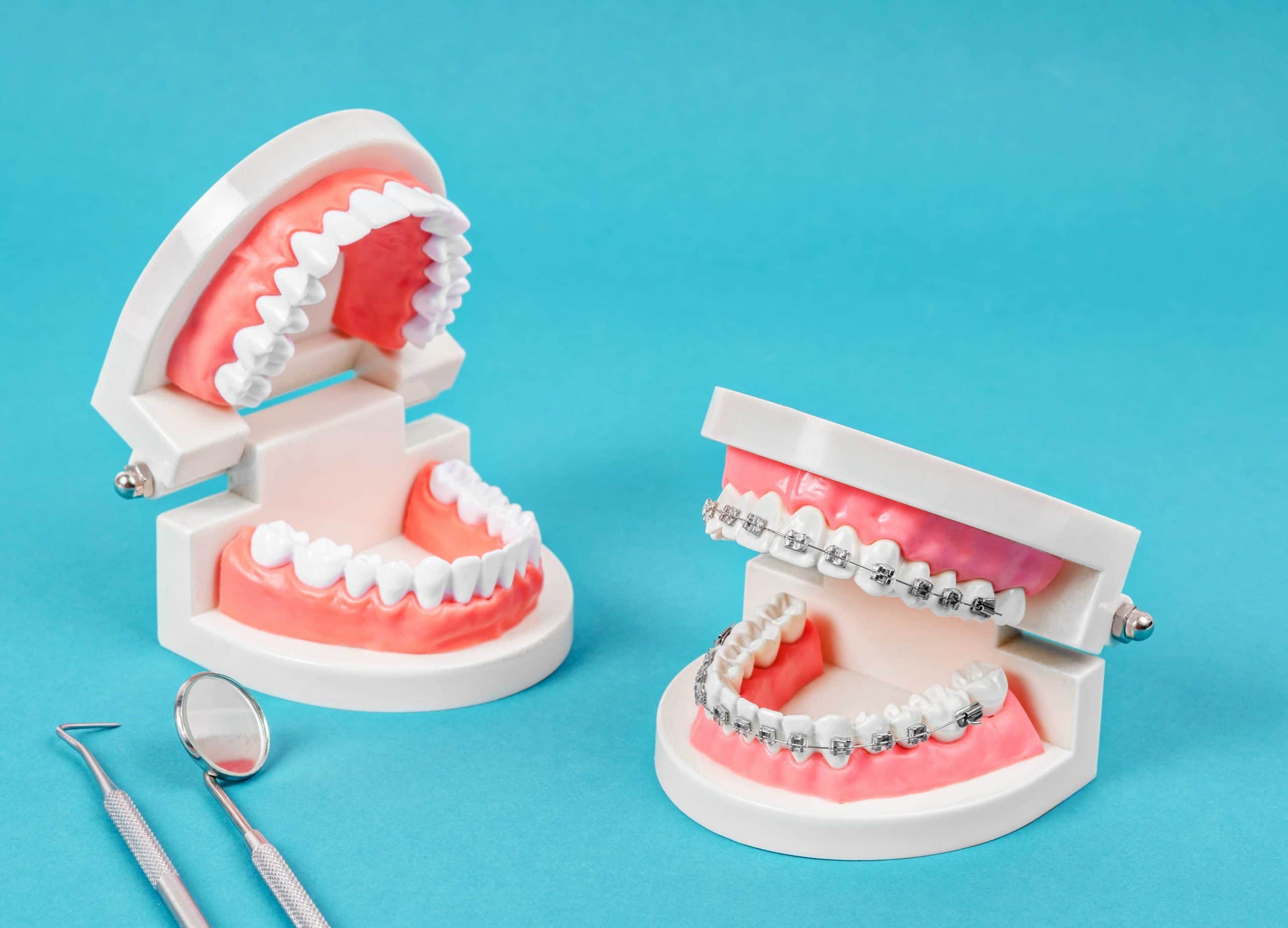 How are Metal and Ceramic Braces Different?  Kossowan OrthodonticsKossowan  Orthodontics