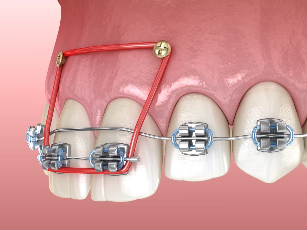 Orthodontic Treatment: Understanding The Benefits For Your Oral Health 