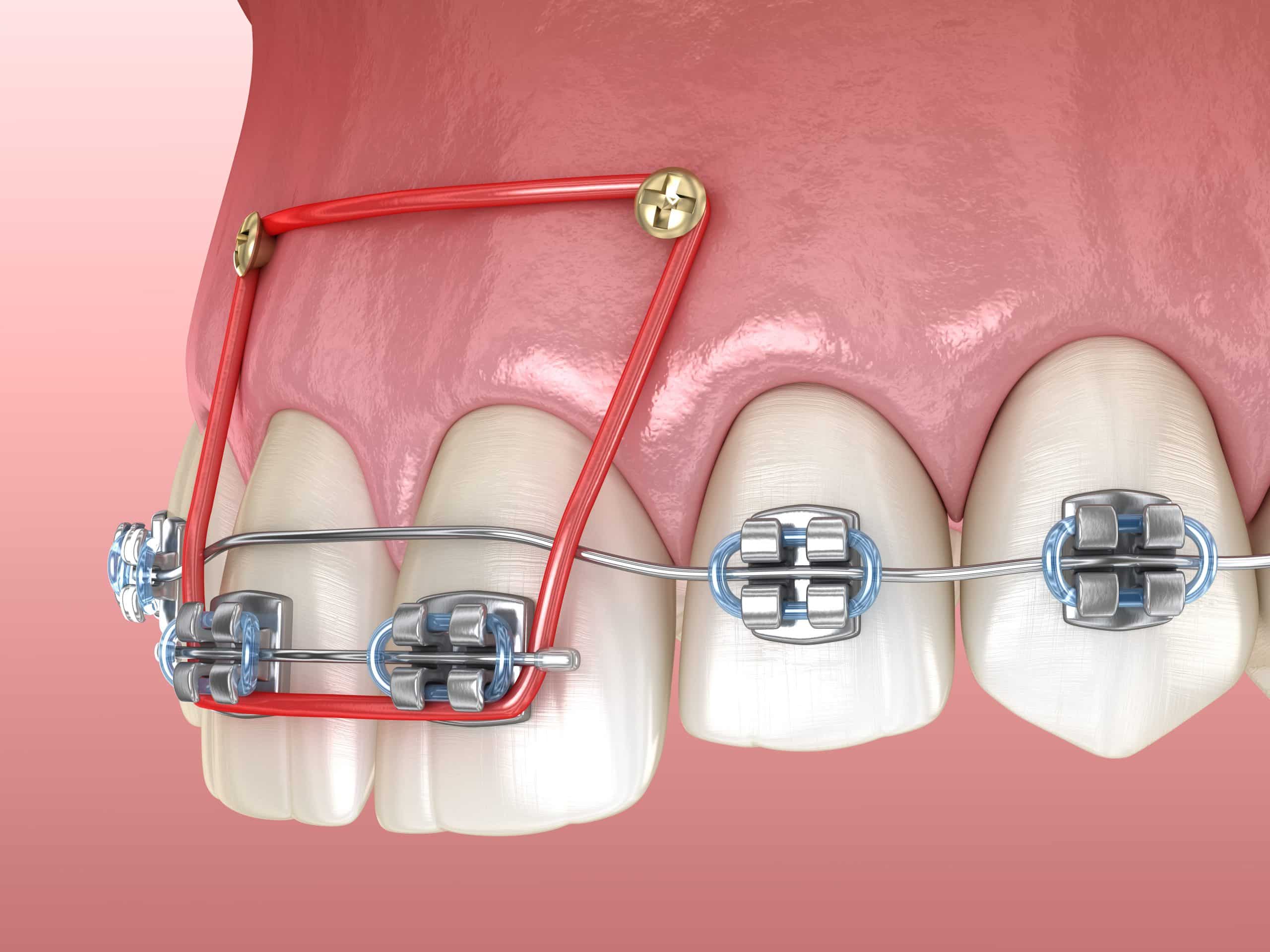 Orthodontic treatment can improve the alignment