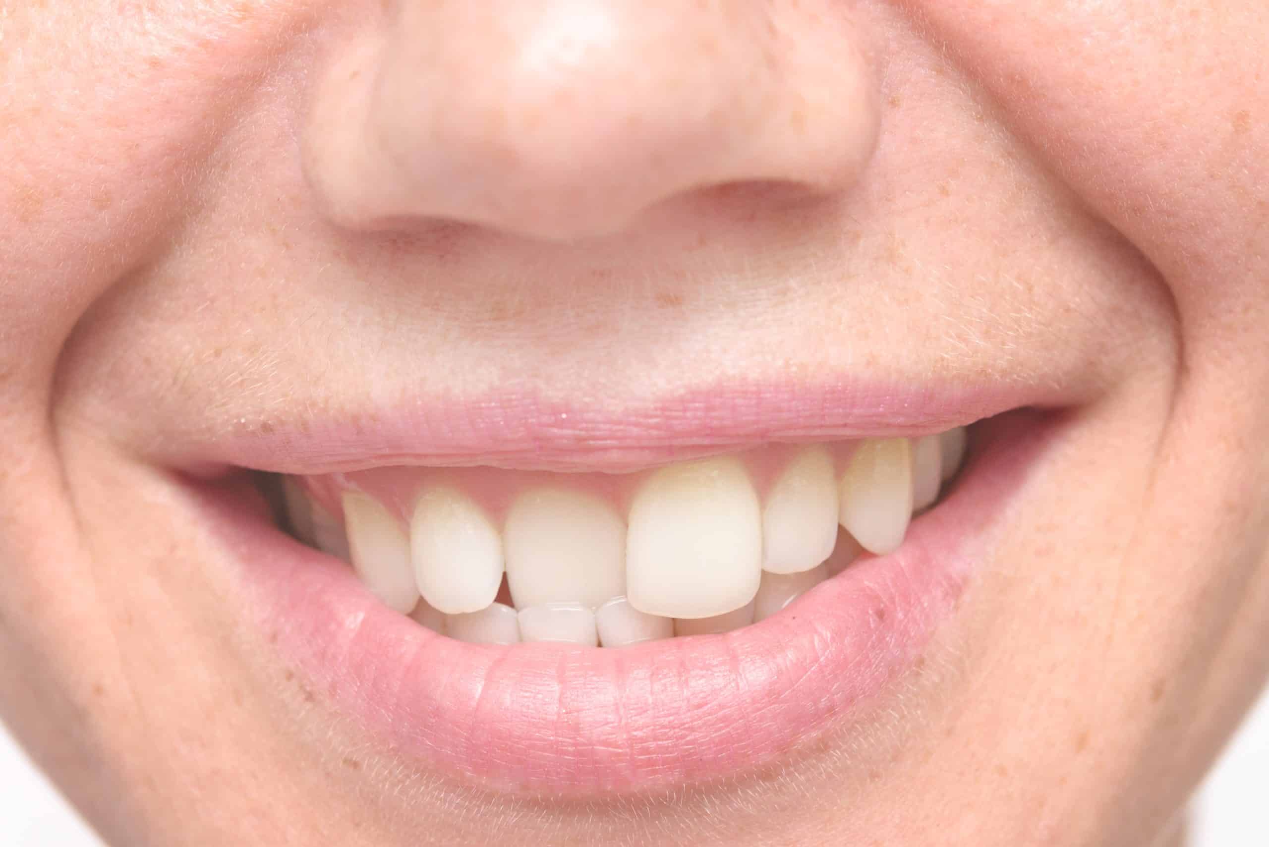 Causes of Crooked Teeth in Adults