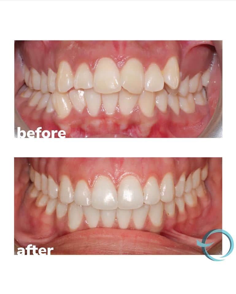 Amazing Smile Transformations with Brace