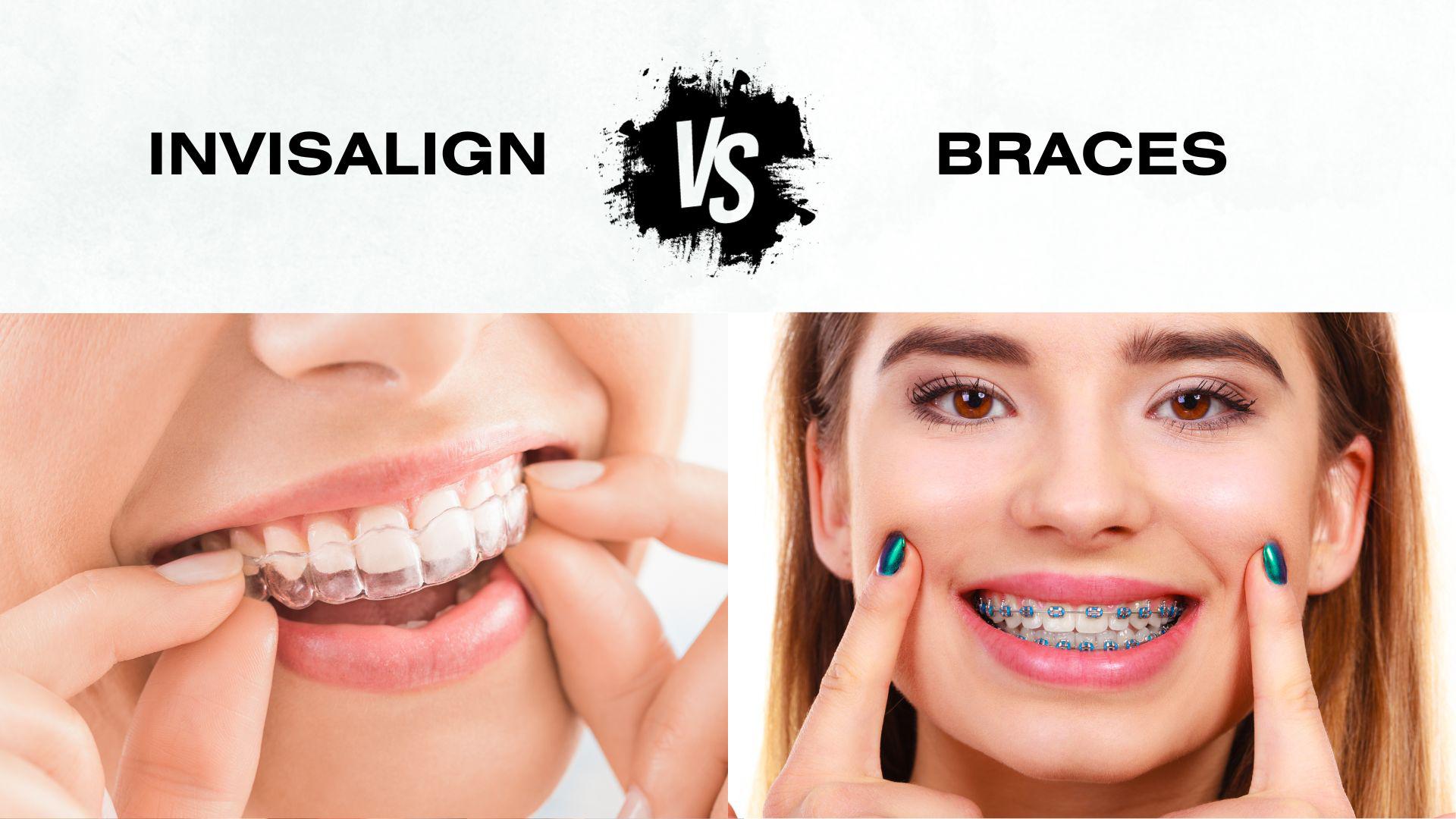 Invisalign Vs Braces