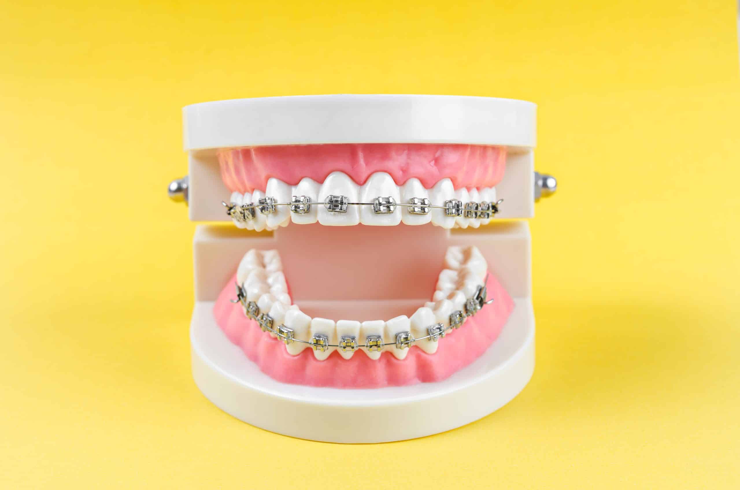 What is the cost of dental braces?